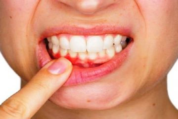 5 Proven Ways To Prevent Bleeding Gums